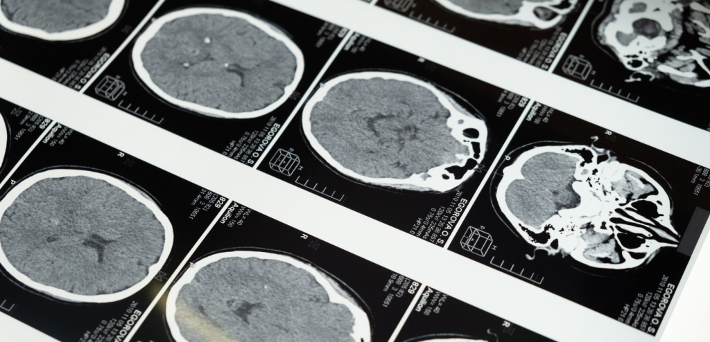 Leucoaraiosis: ¿cómo y por qué sucede? #fisiopatología